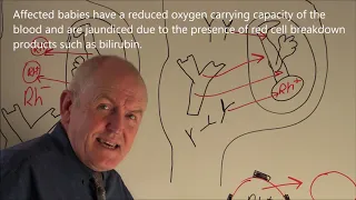 Rhesus Factor Incompatibility