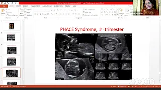 DEEP DIVE INTO THE  FETAL  CNS