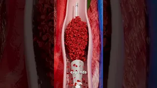 Removing Blood Clots with Vacuum😳#shorts #viral