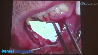 Видео-операция 3 “Установка имплантата OT-F1, OT Medical”, Доктор Хансйорг Хайдриг (Германия)