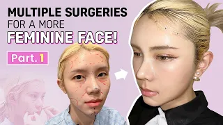 [SUB] Full-face Transformation in Korea Plastic Surgery Hospital Done Safely in ONE Day | RESULTS