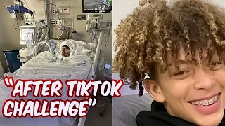 TikTok Challenge  Left Teenager Severely Disfigured with 80% of Body Burned