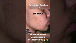 МОЩНЫЙ РЕЗУЛЬТАТ МИНОКСИДИЛА ЗА 1,5 МЕСЯЦА!!!