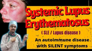 "Understanding SLE Lupus: Treatment Options, Lupus Nephritis, and Lupus Blood Disorders and NMOSD"