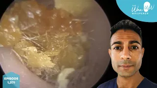 1,071 - Fully Blocked Dry Ear Wax Removal