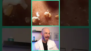 Derm reacts to excessive blackhead extractions! #dermreacts #doctorreacts #blackheads