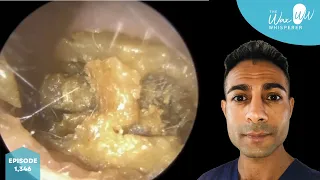 1,346 - Severely Blocked Ear Wax Removal with Microsuction & Ear Hook