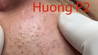 Make your Acne Treatment Huong Da Nang#490 part 2 | acne 2022