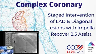 Staged Intervention of LAD & Diagonal Lesions w/ Impella Recover 2.5 Assist -June 2011 Webcast Video