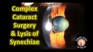 Complex Cataract Surgery: multiple challenging issues