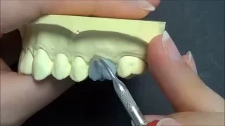 Live wax up- Upper 1st molar(contour)