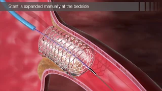 Chapter 20 - CorPath: Robot Assisted Coronary Intervention