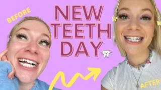 My Composite Bonding Journey | NEW TEETH DAY | Q&A Vlog