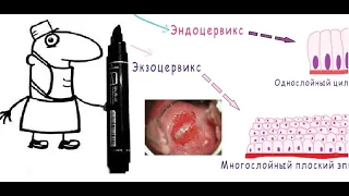 Эрозия шейки матки: когда лечить не нужно и что такое псевдоэрозия?