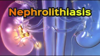 Nephrolithiasis (Kidney Stones) - CRASH! Medical Review Series