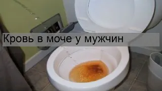 Кровь в моче у мужчин