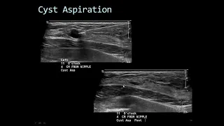 Breast Intervention Part 2, Dr Carolynn Debenedectis - MRI Online Noon Conference