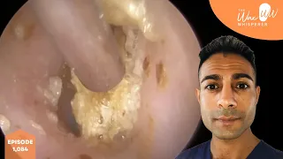 1,084 - Post Swimming Blocked Ear Wax Removal