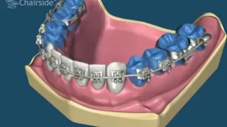 Ортодонтія, брекети, вирівнювання зубів
