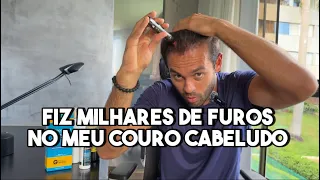 MEU PROTOCOLO COMPLETO DE REVERSÃO DE QUEDA DE CABELO E CALVÍCIE