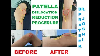 PATELLA DISLOCATION REDUCTION PROCEDURE | DR. PRATEEK JOSHI