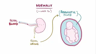 Renal agenesis