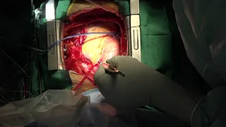 Thoracic Aortic Aneurysm /Total Arch Replacement Frozen Elephant trunk/胸部大動脈瘤に対する全弓部置換＋オープンステント留置術