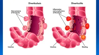 Hablamos sobre los divertículos y sus peligros