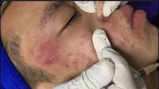 Acne treatment under the skin #008 / Spa Linh Mun