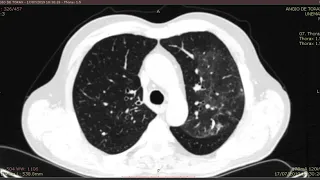 Angio TC de Artérias Pulmonares |Tromboembolismo pulmonar agudo