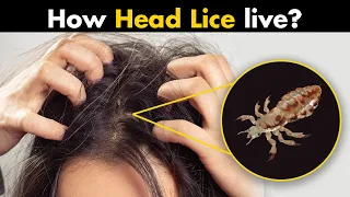 Head Lice | How They Live? | Life Cycle Of Head Lice (Urdu/Hindi)