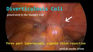 Diverticulosis Coli. Penetreted to the Bladder. Metin Ertem MD.FACS