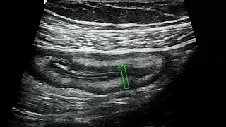 Terminal ileitis ultrasound case