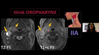 The "How To" of Neck Nodes, Dr. Christine Glastonbury - MRI Online Noon Conference