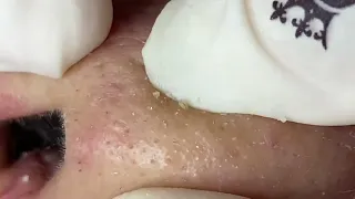 SAC DEP SPA Blackheads | #1177