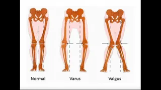 Valgus & Varus Forces on the Knee | MCL vs LCL Injuries