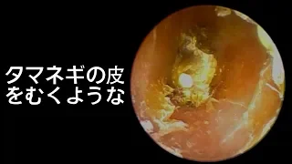 Relaxing Earwax Removal -- Just Like Peeling An Onion