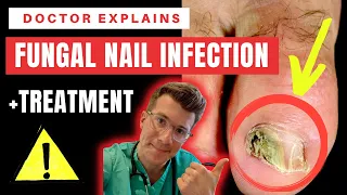 How to recognise, diagnose & treat FUNGAL NAIL INFECTION (Onychomycosis) | Doctor O'Donovan explains