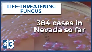 384 life-threatening fungus cases so far in Nevada, health officials highly alert