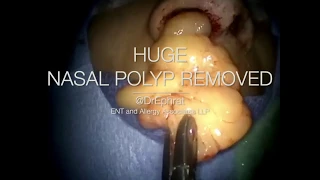 Huge Nasal polyp removal!