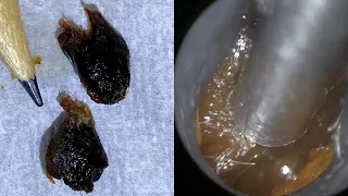 52 - Extra Large Ear Wax Plugs Removed using WAXscope®️