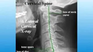 Auto Accidents and Your Spine