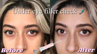 GETTING UNDER EYE FILLER INJECTIONS FOR MY DARK CIRCLES VLOG + BEFORE AND AFTER (again lol)