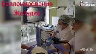 Желудочный баллон для похудения Алматы. Хирург Никонов Игорь.