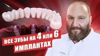 🇺🇦 Имплантация «все на 4 и 6» имплантах — в чем отличие