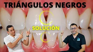 ¿Tienes huecos/triángulos negros entre los dientes? | Tratamiento y Causas