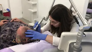 Удаление кератозного новообразования Dr Beauty