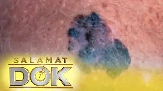 Salamat Dok: Melanoma and cancerous moles