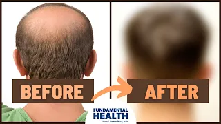 Can the carnivore diet help with hair loss?