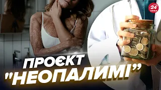 ❗Українці можуть БЕЗКОШТОВНО лікувати опіки та рубці! / ДЕТАЛІ